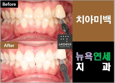 스탠다드치아미백,치아미백,스탠다드미백,연예인치아미백