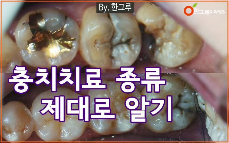 공덕역치과, 충치 치료를 인레이로