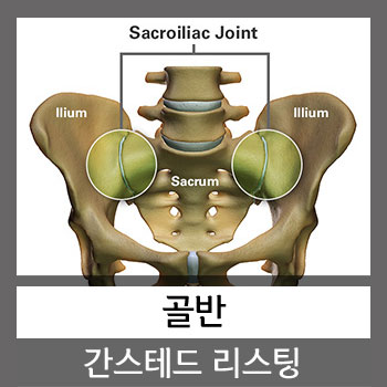  천장관절(S-I Joint) 기능 이상과 골반 카이로프랙틱 간스테드 리스팅