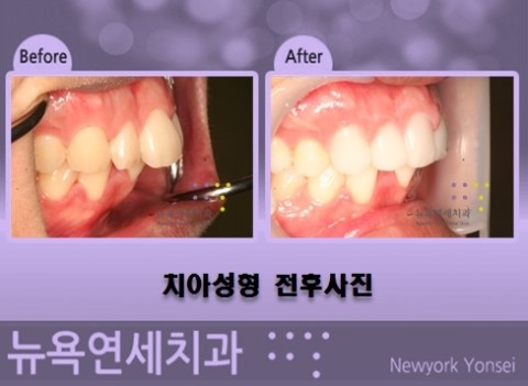  #앞니교정병원,앞니교정,앞니교정방법,앞니올세라믹성형#