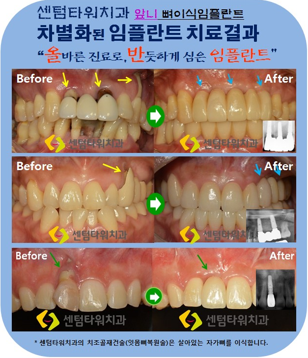 부산앞니임플란트에 대해서 3
