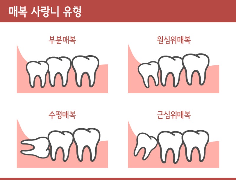 부산사랑니치과 세종치과의 안전하고 체계적인 사랑니 발치 7