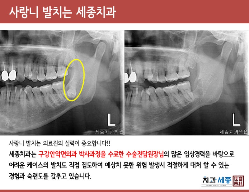 부산사랑니치과 세종치과의 안전하고 체계적인 사랑니 발치 6