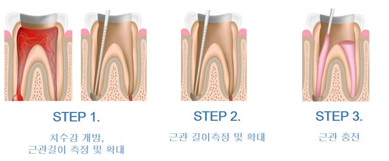 근관 치료에 대해 자세히 알아보기 3