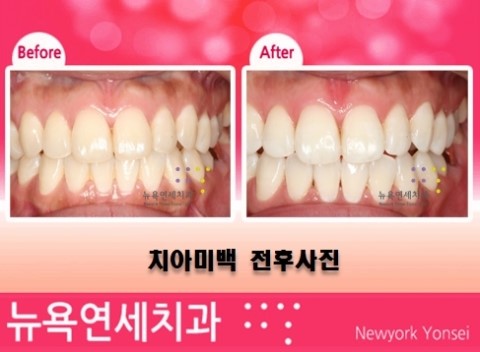  미백치료,앞니미백치료,치아미백시술,전문가앞니미백
