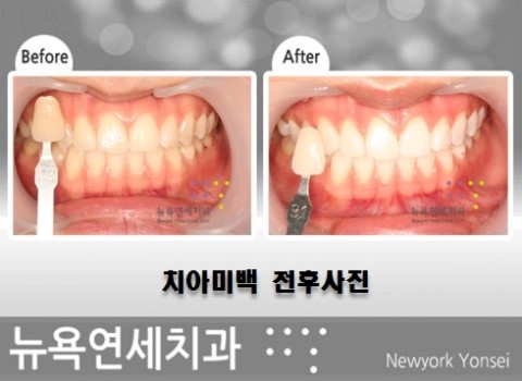  전문가미백,전문가치아미백,전문가미백치과,전문가치아미백병원