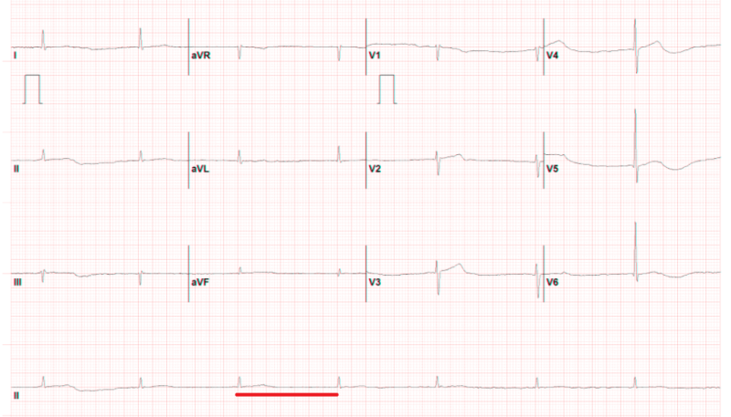 부정맥의 노작성 호흡곤란; 심방세동(atrial fibrillation), 방실차단(AV node block)(+-접합부성 리듬 ...