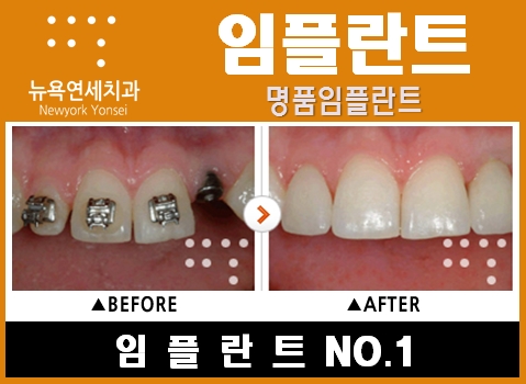  #임플란트전후사진,임플란트전후,임플란트효과,임플란트과정#