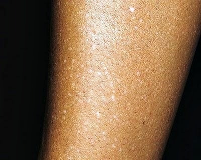 이토 멜라닌저하증(Hypomelanosis of ito) : 네이버 블로그