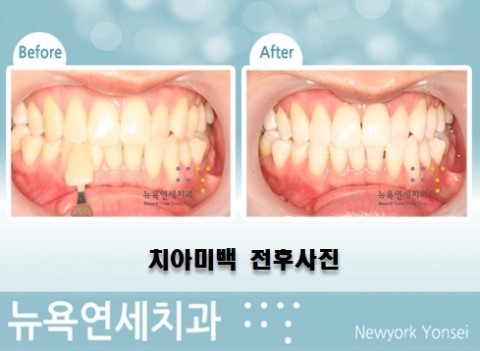 치아미백상담,치아미백문의,치아미백술,치아미백시술비용