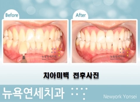  치아미백상담,치아미백문의,치아미백술,치아미백시술비용