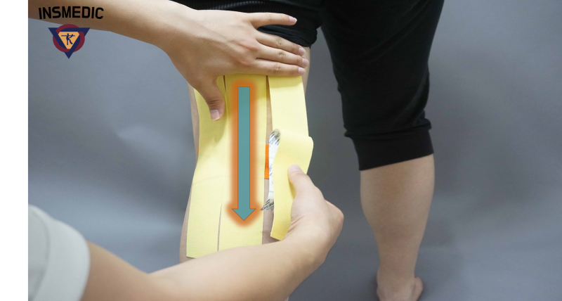 [국제테이핑] 무릎 뒤쪽(오금) 통증시 테이핑!! : 네이버 블로그