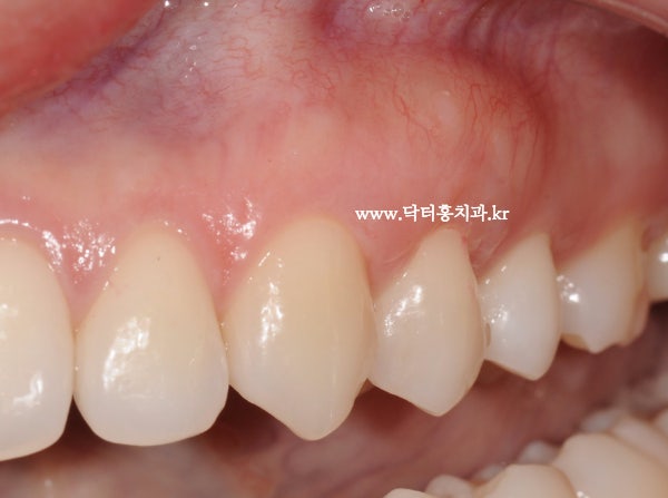 교정 후 잇몸퇴축, 하전치하행치경재생술