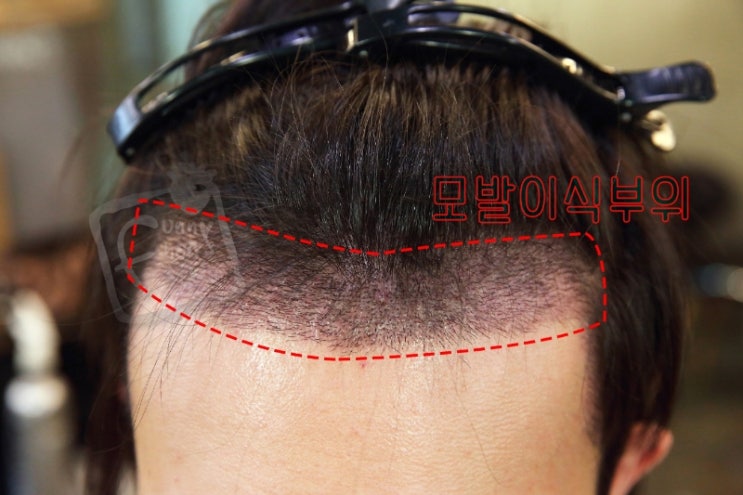  모발이식 후 암흑기 동반탈락 쉐딩현상 극복 퍼니M 테이프 스티커붙임머리