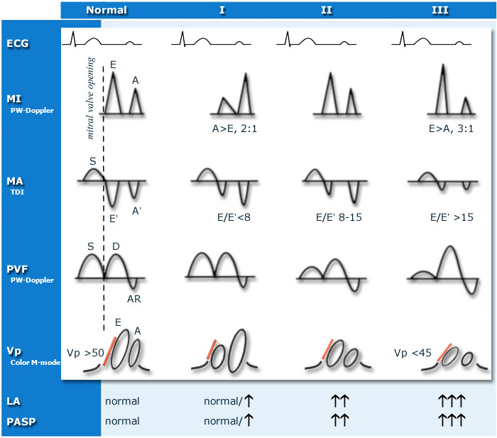 Doppler echocardiography, Transmitral velocity curve (mitral inflow ...