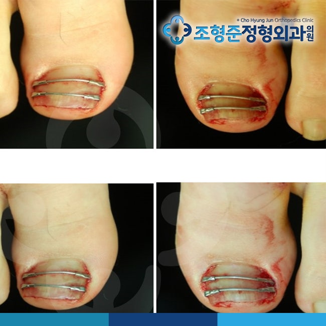 내성발톱 치료법 무엇이 좋을까요? : 네이버 블로그 내성발톱 치료법 무엇이 좋을까요? : 네이버 블로그