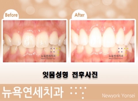  ##거미스마일치료방법,거미스마일수술,잇몸성형수술방법,잇몸수술치과##