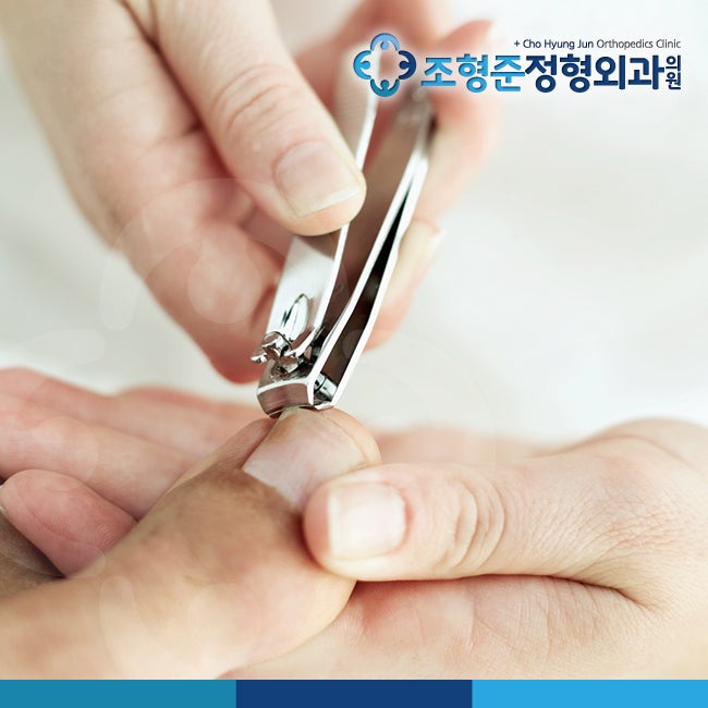 내성발톱 치료법 무엇이 좋을까요? : 네이버 블로그 내성발톱 치료법 무엇이 좋을까요? : 네이버 블로그