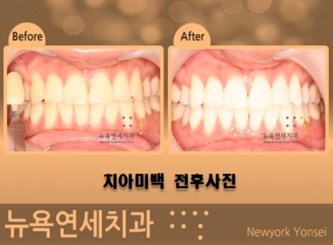 치아미백효과,치아미백후,치아미백결과,치아미백사진