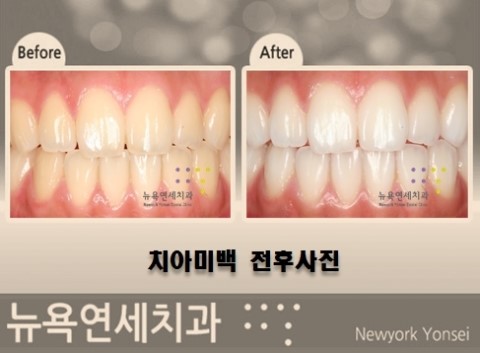 전문가치아미백,치아미백효과,치아미백전문치과,치아미백추천
