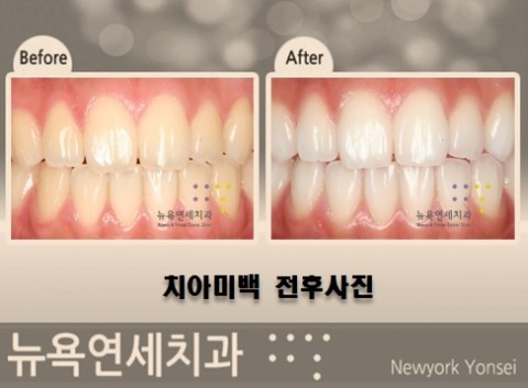  전문가치아미백,치아미백효과,치아미백전문치과,치아미백추천