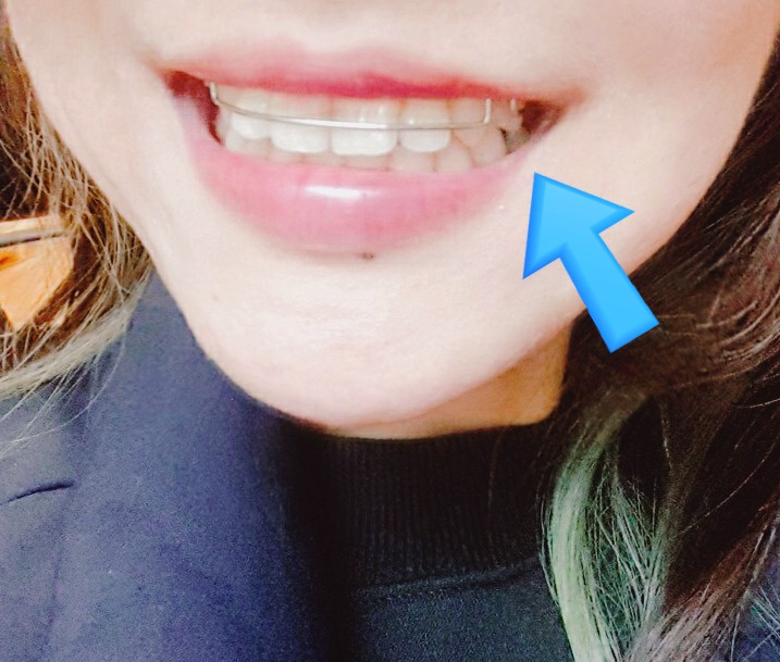 치아교정유지장치 착용기간/세척법 요점정리!✓ : 네이버 블로그