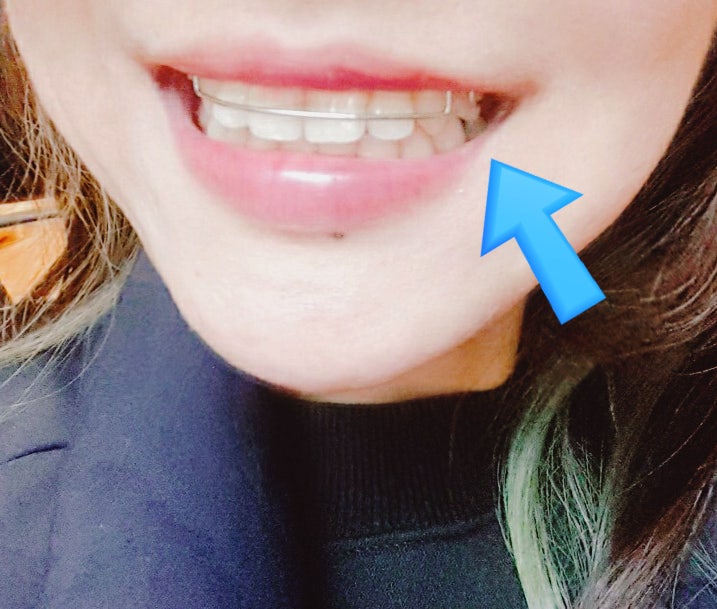 치아교정유지장치 착용기간/세척법 요점정리!✓ : 네이버 블로그 치아교정유지장치 착용기간/세척법 요점정리!✓ : 네이버 블로그