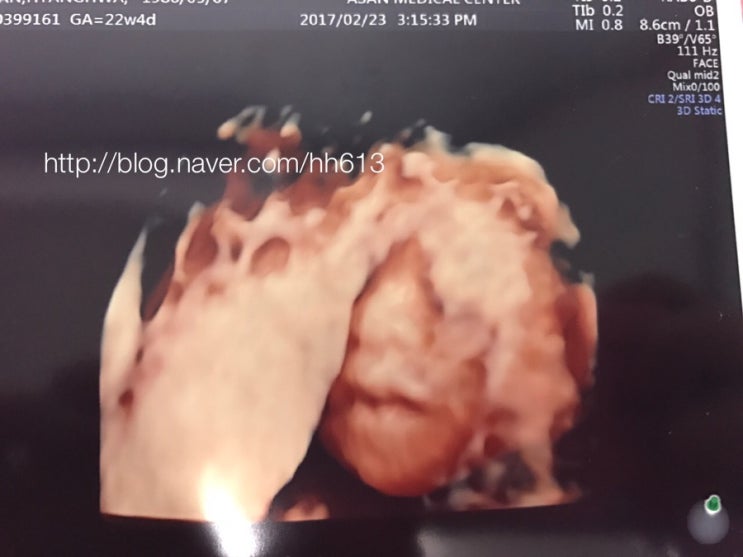 임신 22주 경부길이 2cm::정밀초음파검사