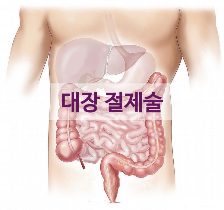 대장절제술 후유장해보험금 대상 가능한가?