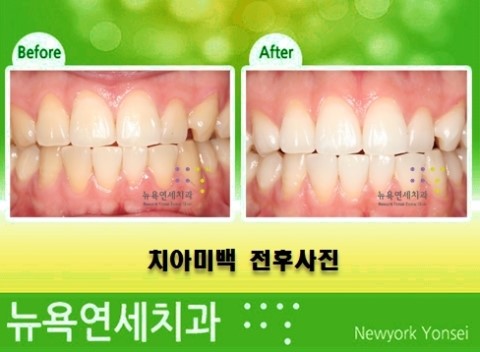  치아미백병원,치아미백전문치과,치아미백제품,치아미백결과