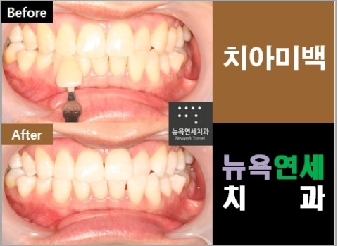  치아미백의종류,치아미백프로그램,미백종류,치아미백추천