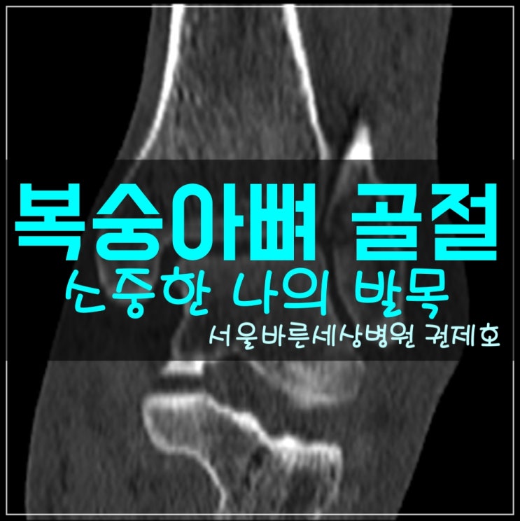 복숭아뼈 골절, 발목 골절 : 개방적 정복술 및 금속판 고정하는 방법 / 서울바른세상병원 권제호
