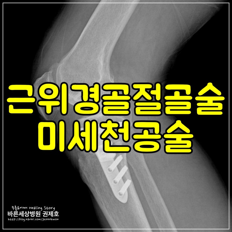  독산동 정형외과 : 근위경골절골술 단점과 수술의 위험성 및 합병증 / 서울바른세상병원 권제호
