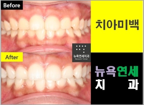  원데이치아미백과정,원데이치아미백,원데이치아미백사진,원데이치아미백병원