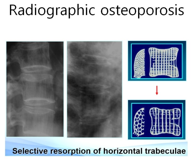 아마인유(Flaxseed oil)와 골다공증(Osteoporosis) a2