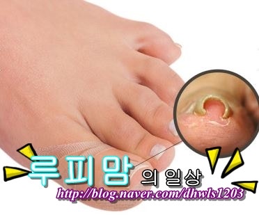 파고드는 내성발톱 병원가지마세요. : 네이버 블로그 파고드는 내성발톱 병원가지마세요. : 네이버 블로그