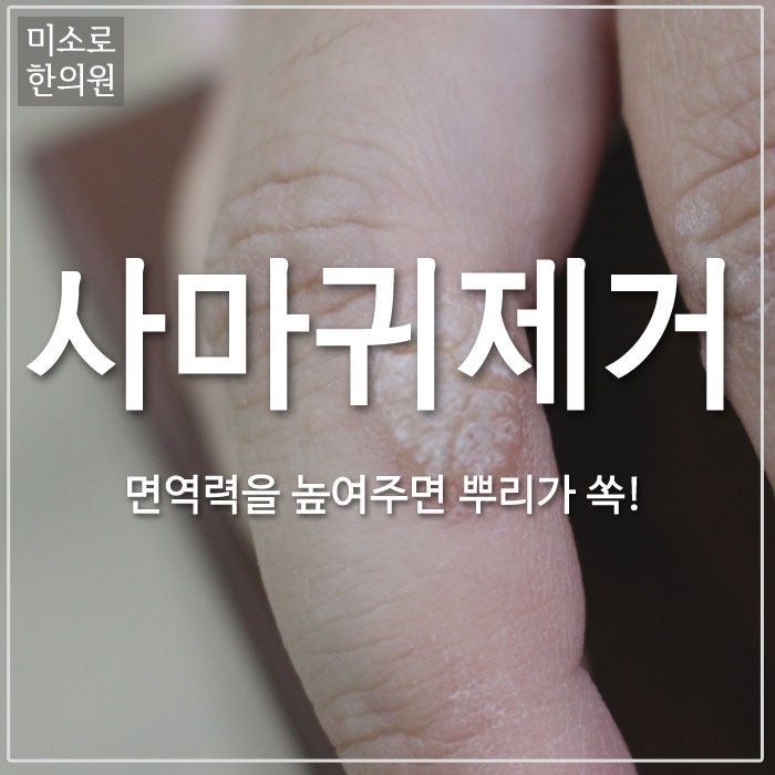 대전사마귀한의원 제거치료 시간이 걸리더라도 5
