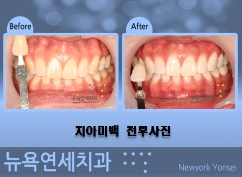  치아미백추천,치아미백,치아미백잘하는곳,치아미백병원추천