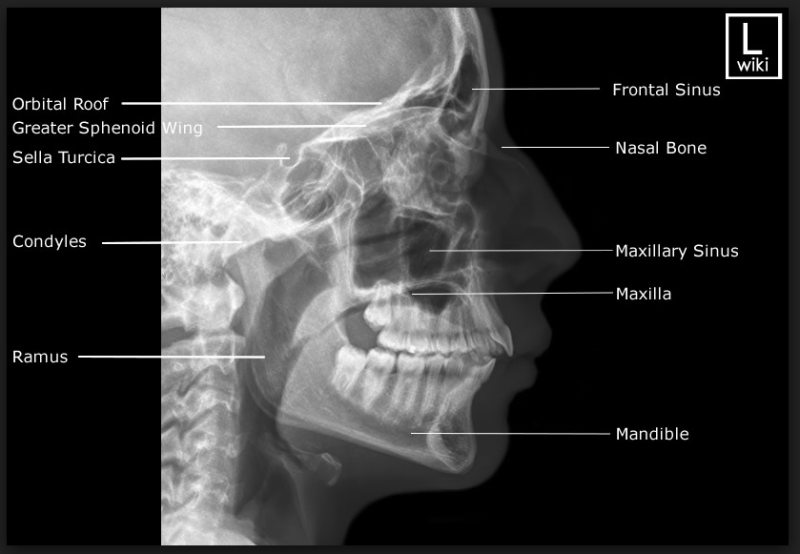 √ Pns X Ray Lateral View