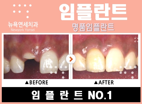  앞니임플란트방법,앞니임플란트사진,앞니임플란트수술,앞니임플란트시술