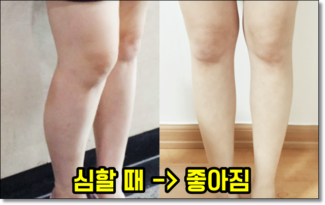  종아리 부종까지 싹 잡는 효과적인다이어트방법