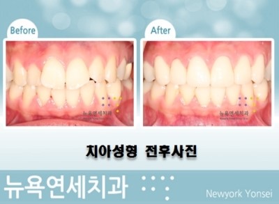  앞니교정시술,라미네이트시술,올세라믹시술,앞니치아성형시술