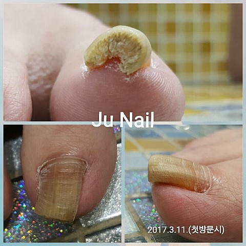 무좀과파고드는발톱/분당용인수지보정죽전동/주네일 무좀과파고드는발톱/분당용인수지보정죽전동/주네일