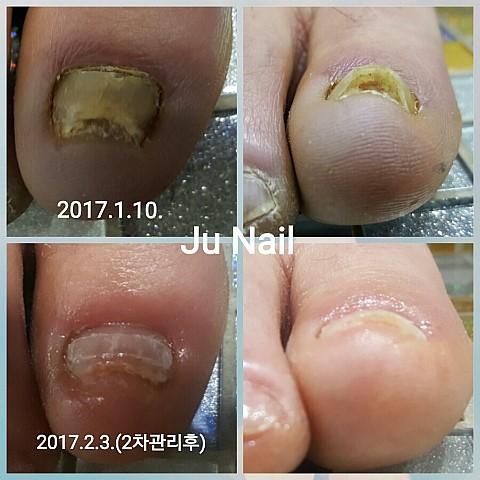 파고드는발톱/분당용인수지보정죽전/주네일