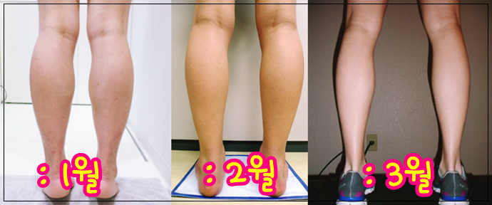  종아리보톡스효과 보고싶어? 옛다 종아리살 빼는법