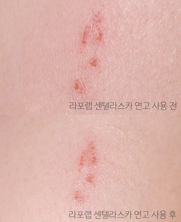  병풀크림 하면 또 센텔라스카연고지! 사용후기