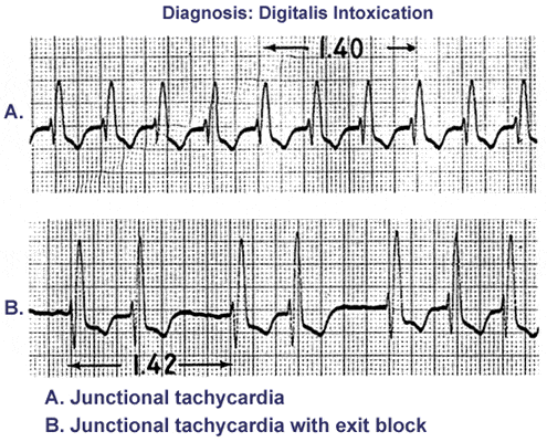 Av Junctional Arrhythmia Junctional Premature Complex Junctional Tachycardia 네이버 블로그 Av Junctional Arrhythmia Junctional Premature Complex Junctional Tachycardia 네이버 블로그