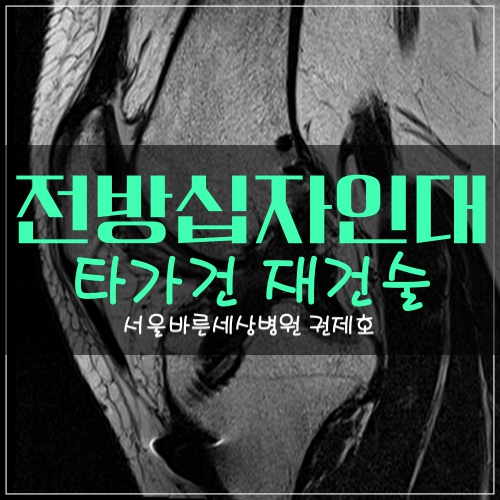  전방십자인대파열 타가건을 이용한 십자인대재건 치료 방법 양천구 정형외과 제이본 권제호