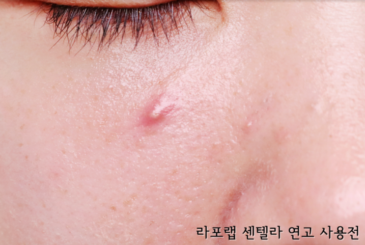  여드름 색소침착 연고 내가 쓴것 중에 최고 센텔라 연고