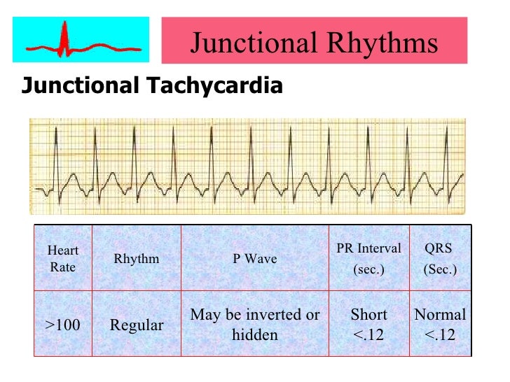 Av Junctional Arrhythmia Junctional Premature Complex Junctional Tachycardia 네이버 블로그